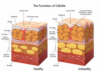 آیا سلولیت با کرم و روغن از بین می رود؟